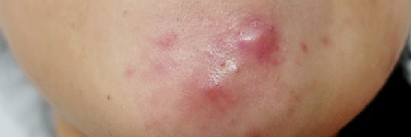 Подкожные прыщи на подбородке причины, лечение и профилактика