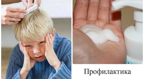 10 лучших средств против вшей — народный рейтинг