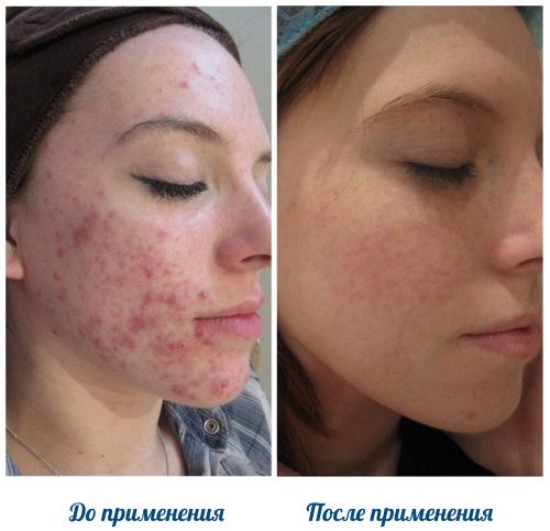 Аккутан инструкция по применению витамина А