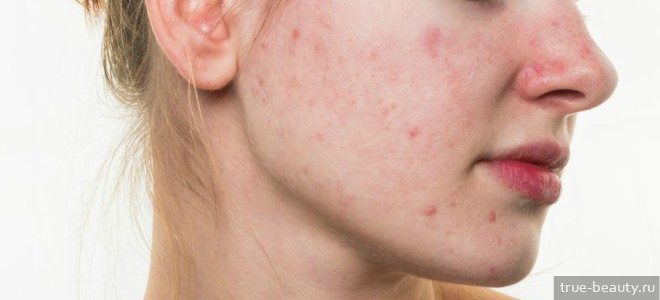 Акне: медикаментозные и аппаратные методы лечения