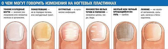 Белые пятна на ногтях рук: причины, их симптомы и лечение