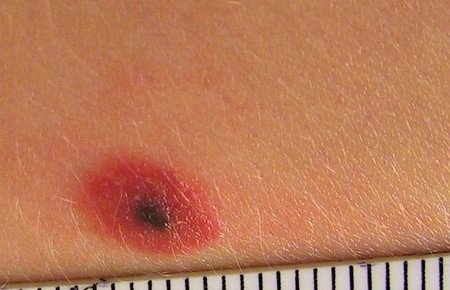 Черная точка на соске: стоит ли бояться