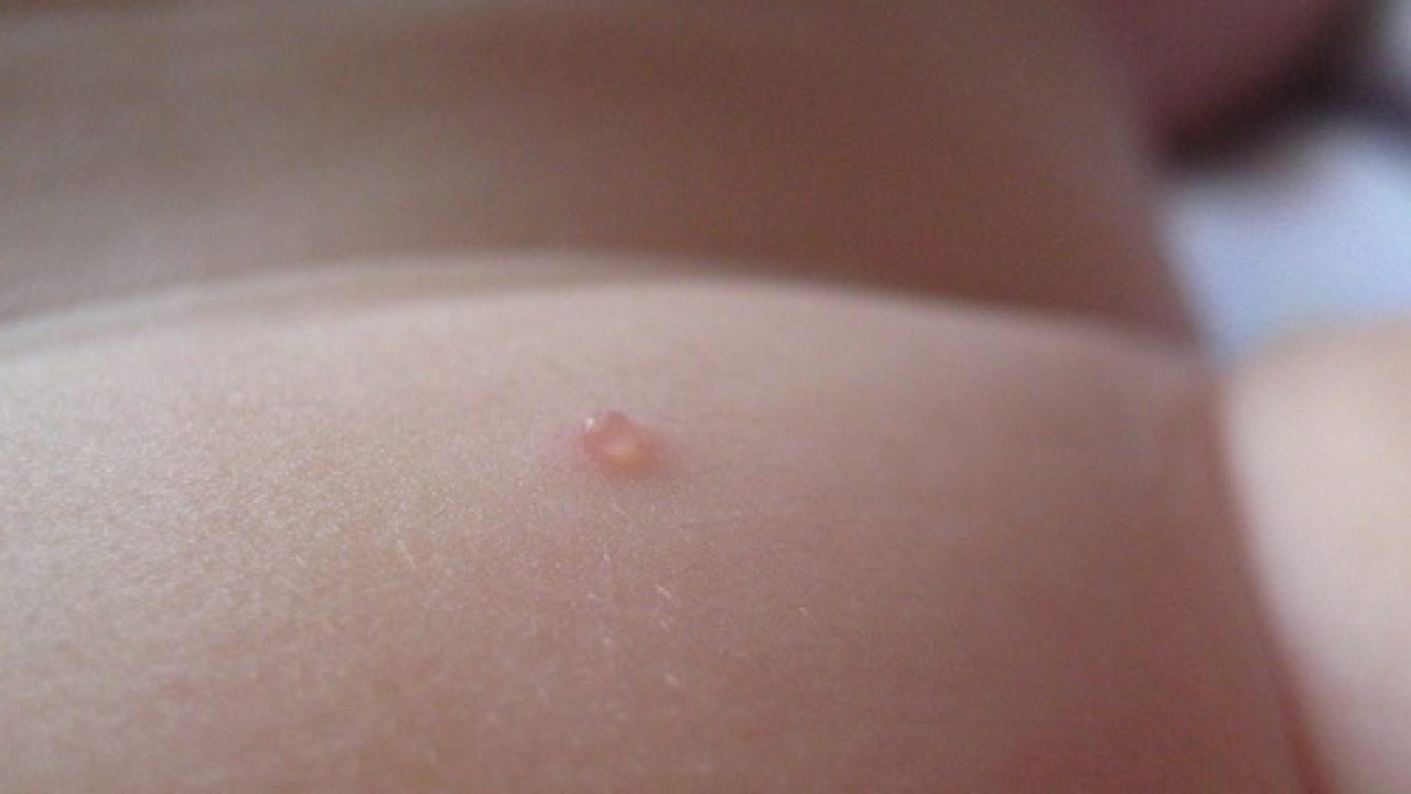 cheshutsya pryshi na tele osnovnye prichiny i sposoby lecheniya