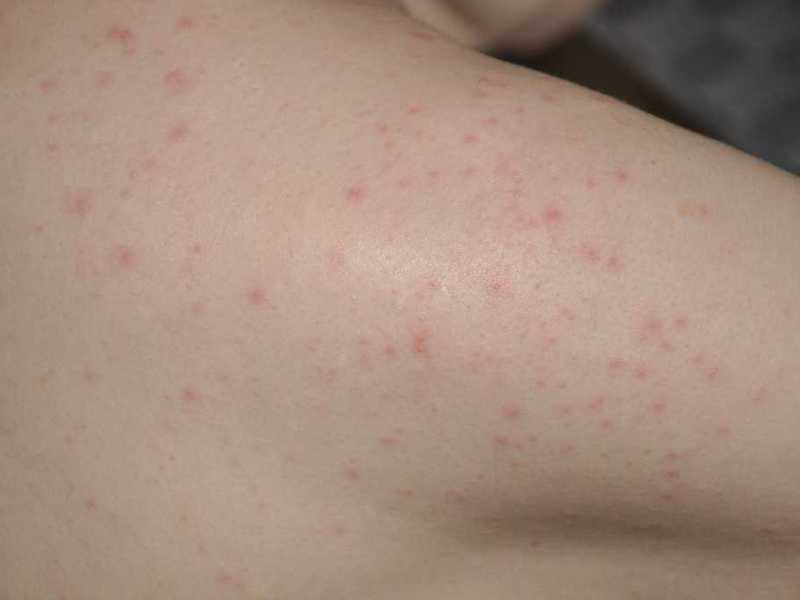 Чешутся прыщи на теле: основные причины и способы лечения
