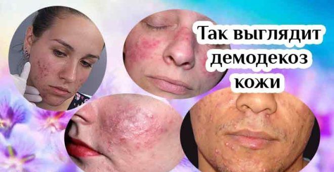 Демодекоз: диагностика и лечение кожи