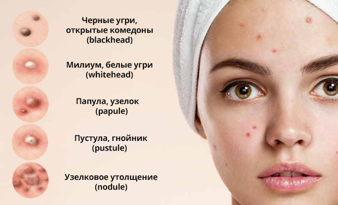 Эффективные гормональные препараты от прыщей