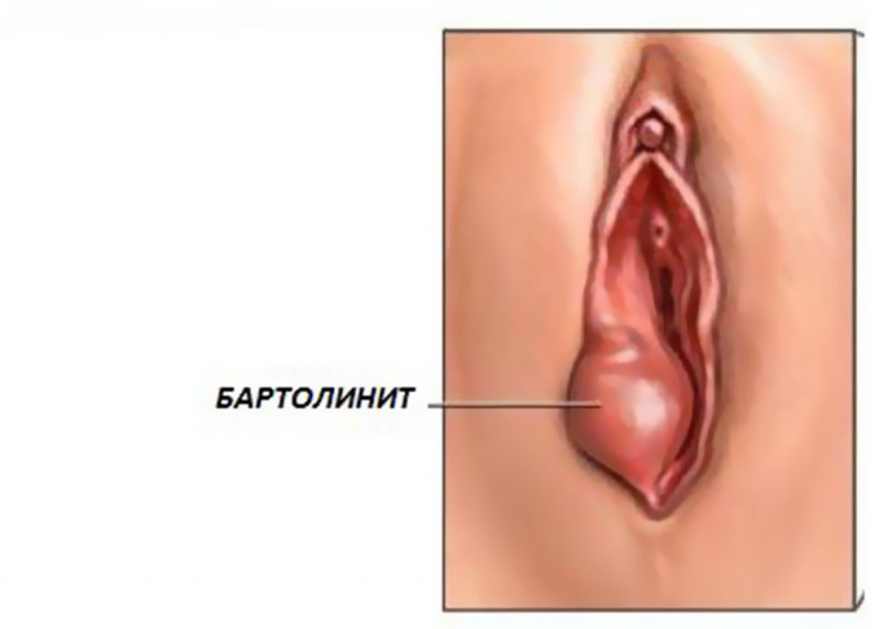 Гнойный фурункул: общая информация, осложнения, диагностика