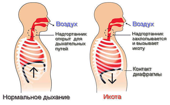 Как избавиться от икоты