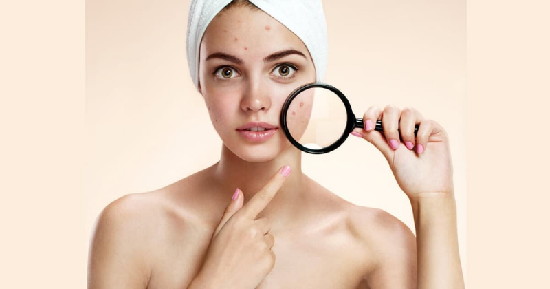 Как избежать появление прыщей?