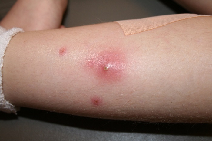 Как лечить фурункул: причины появления и эффективные рекомендации специалистов