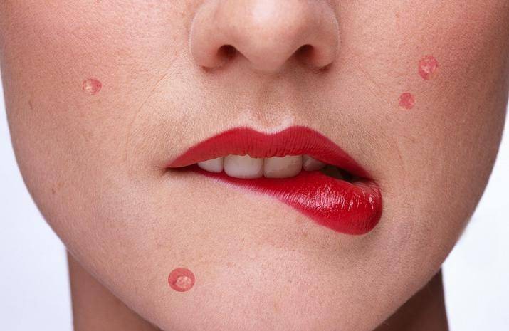 Как лечить фурункул: причины появления и эффективные рекомендации специалистов