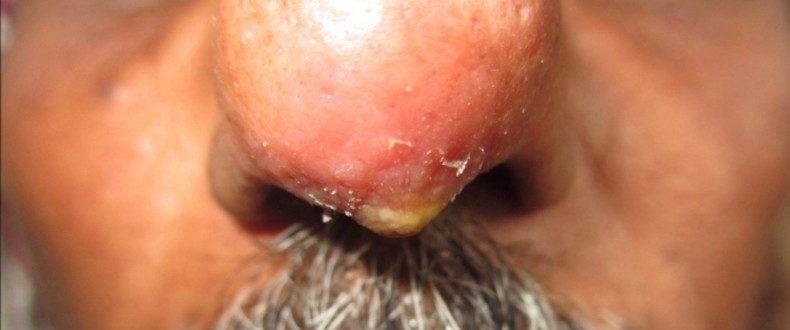 Как лечить фурункул: причины появления и эффективные рекомендации специалистов