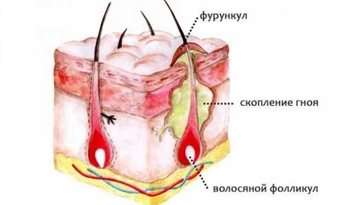 Какой антибиотик при фурункуле назначает врач: обзор препаратов и мазей