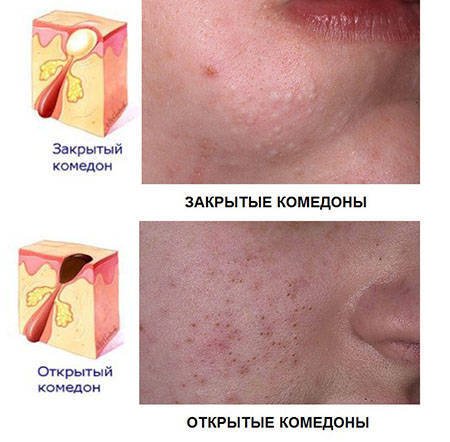 Комедоны на лице: причины появления и способы лечения