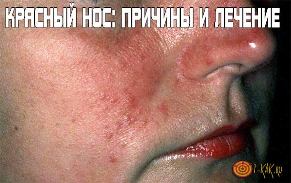 Красный нос: причины появления болезни и способы лечения