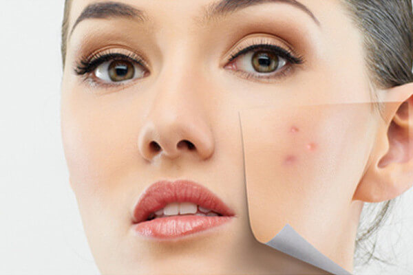 Лечение акне антибиотиками и косметическими средствами