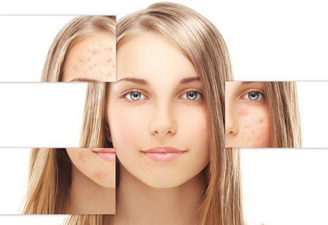 Лечение акне антибиотиками и косметическими средствами