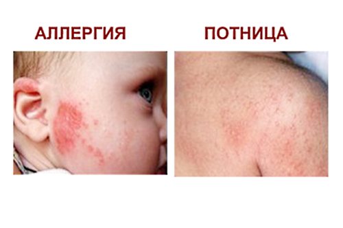 Лечение потнички у новорожденных: советы специалистов по уходу за кожей детей