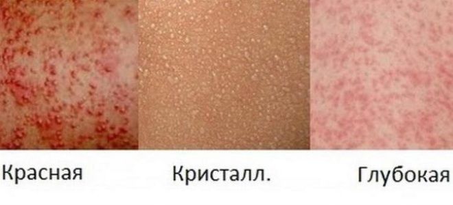 Лечение потнички у новорожденных: советы специалистов по уходу за кожей детей