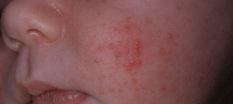Лечение потнички у новорожденных: советы специалистов по уходу за кожей детей