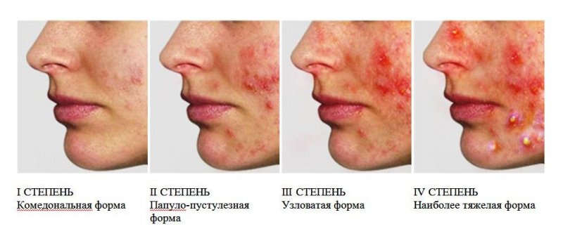 Лечение вульгарных угрей: рекомендации по уходу за кожей и выбору средств