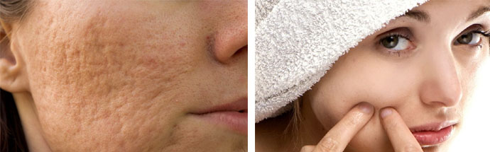 Лимон от постакне: как избавиться от шрамов в домашних условиях