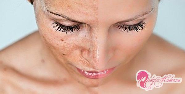 Лимон от постакне: как избавиться от шрамов в домашних условиях