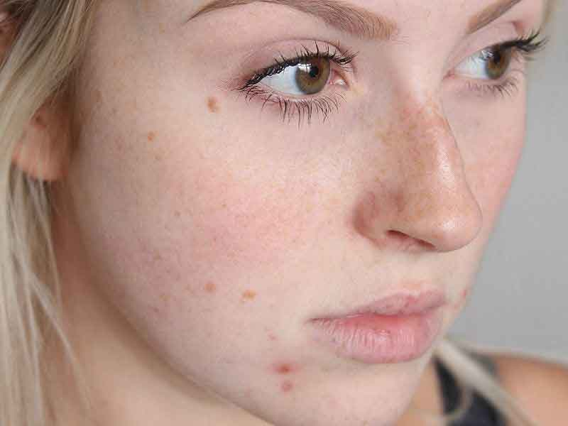 Лимон от постакне: как избавиться от шрамов в домашних условиях