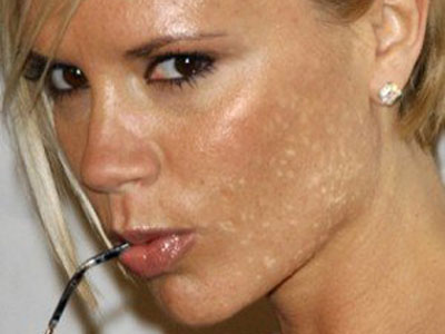 Лимон от постакне: как избавиться от шрамов в домашних условиях