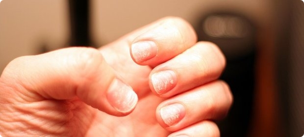 Ломкость ногтей. решение проблемы