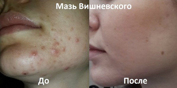 Мазь Вишневского от прыщей: рекомендации специалистов к использованию