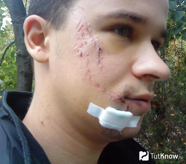 Мазь Вишневского от прыщей: рекомендации специалистов к использованию