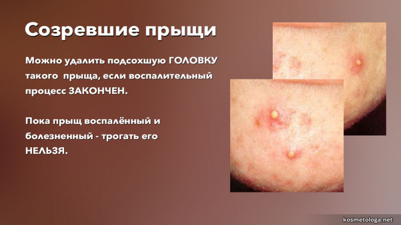 Можно ли давить прыщи – стадии развития и риски возможных осложнений