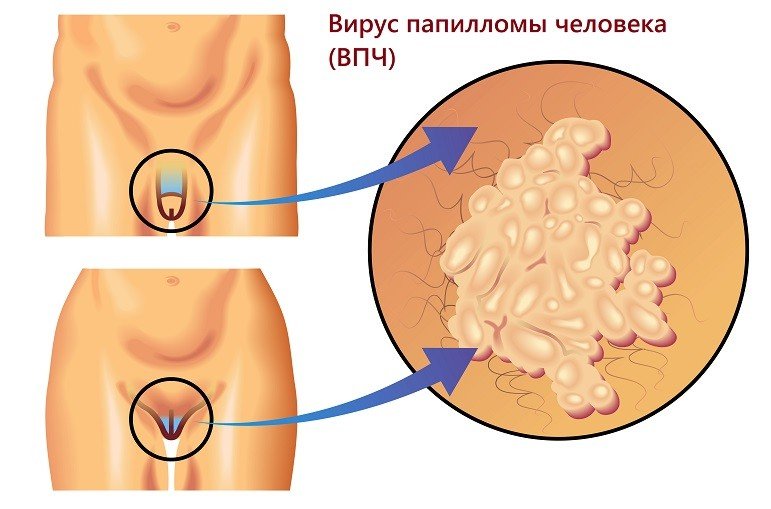 Папилломы: как избавиться от вируса в домашних условиях
