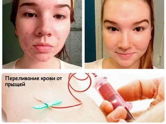 Переливание крови от прыщей: особенности процедуры