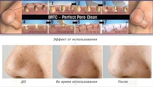Пластырь от черных точек: как правильно пользоваться полосой