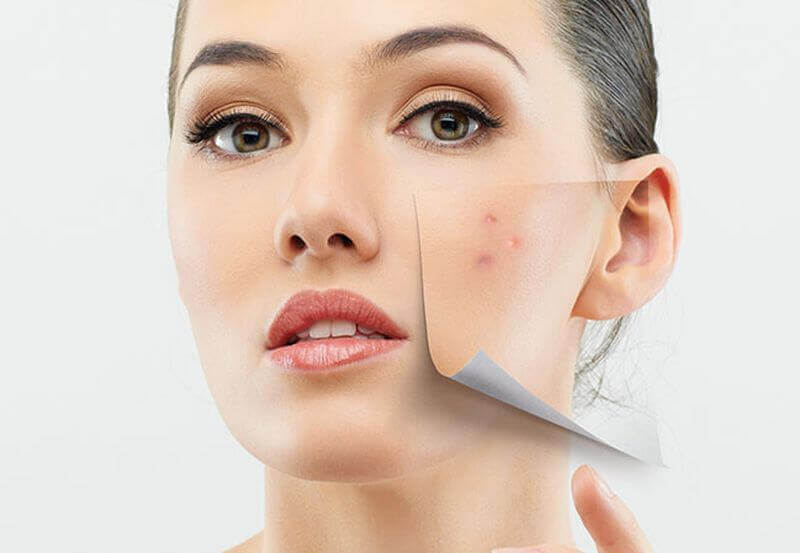 Пробиотики от прыщей: принцип воздействия на воспаления