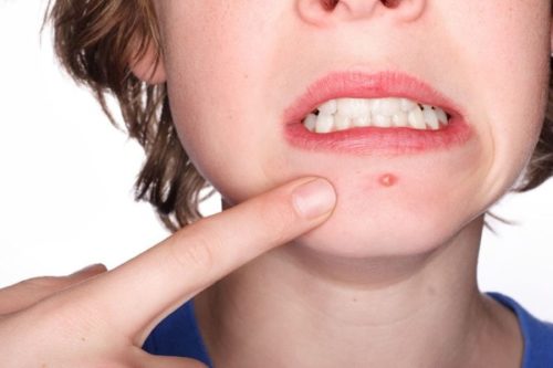 Простудные прыщи: причины появления и лечение