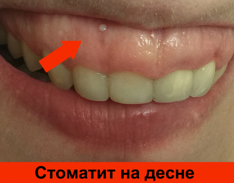 Прыщ на десне у ребенка: причины появления, способы лечения