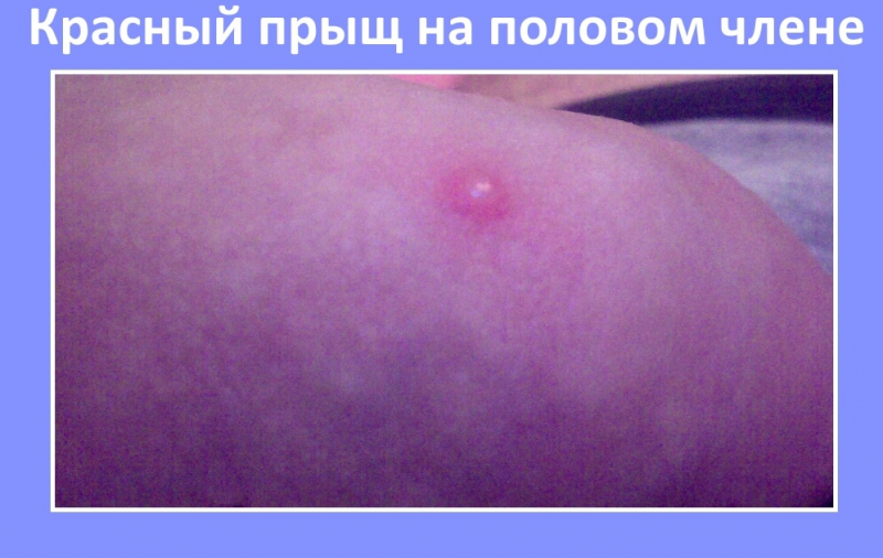 Прыщи на члене: факторы их появления, виды и лечение