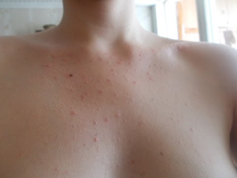 Прыщи на грудной клетке: причины и способы лечения