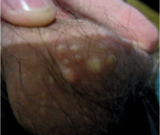 Прыщи на яйцах: от чего появляются и как лечатся