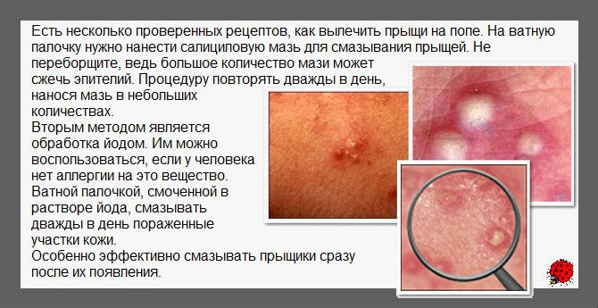 Прыщи на попе: причины, лечение, профилактика