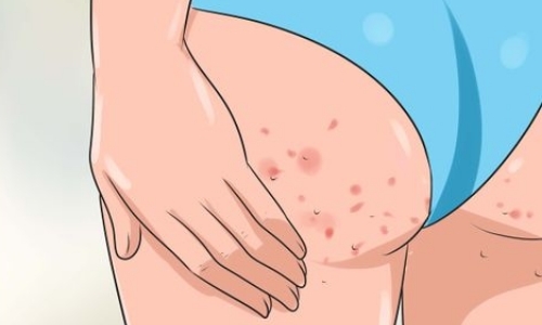 Прыщи на попе у мужчин: обзор всех методов лечения