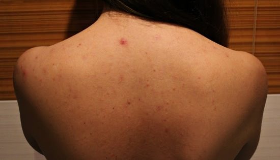 Прыщи на спине: причины появления и способы устранения сыпи