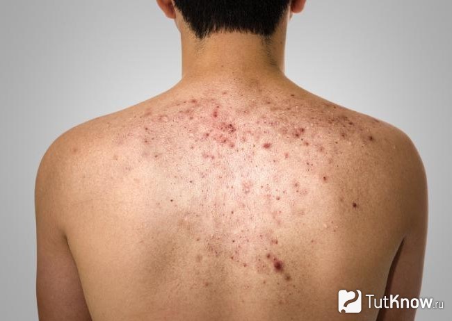 Прыщи на спине: причины появления и способы устранения сыпи