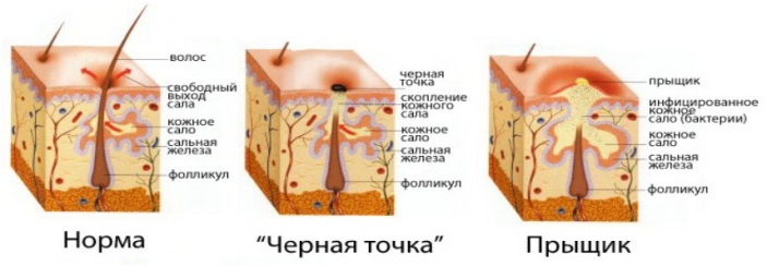 Прыщи на спине: причины появления и способы устранения сыпи