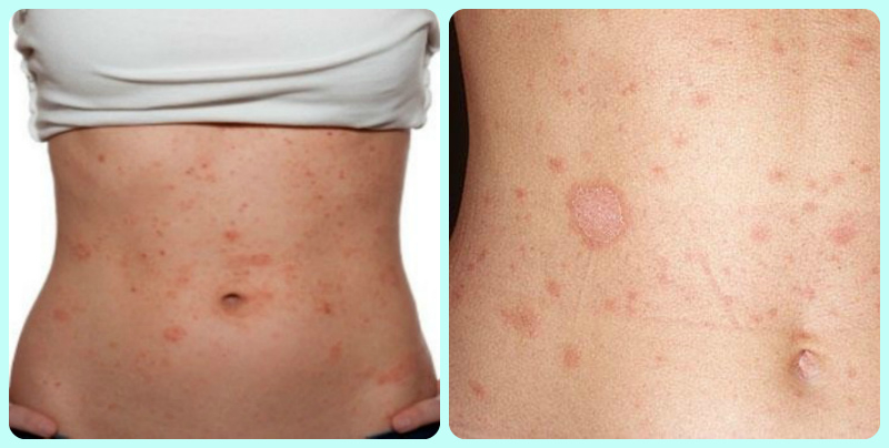 Прыщи на животе: лечение, в зависимости от болезни
