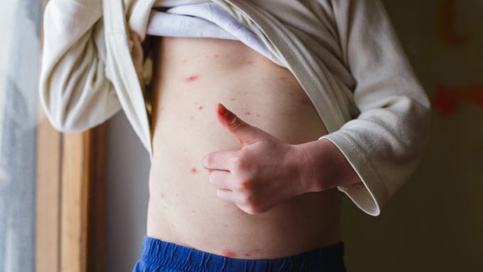 Прыщи на животе: лечение, в зависимости от болезни