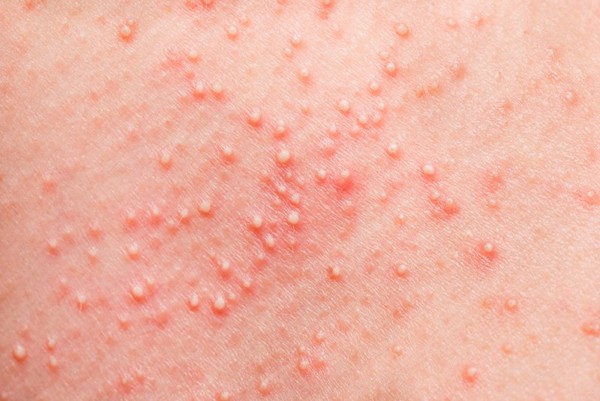 Прыщи после шугаринга: причины появления и способы лечения